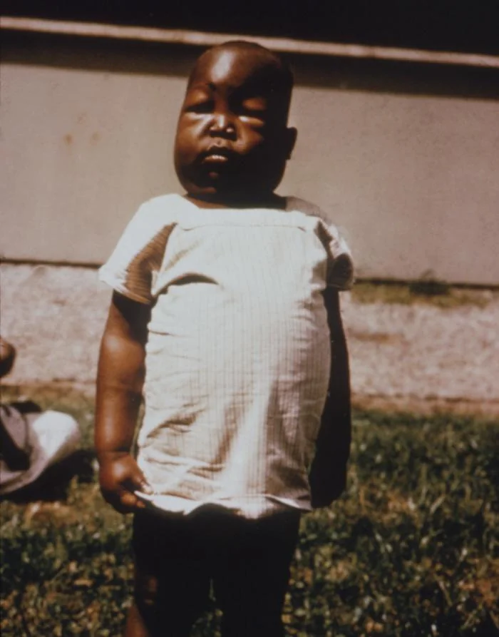 Photograph of a young child with marked generalised swelling of the face and body, with puffy closed eyelids and a distended abdomen, characteristic of severe nephrotic oedema.