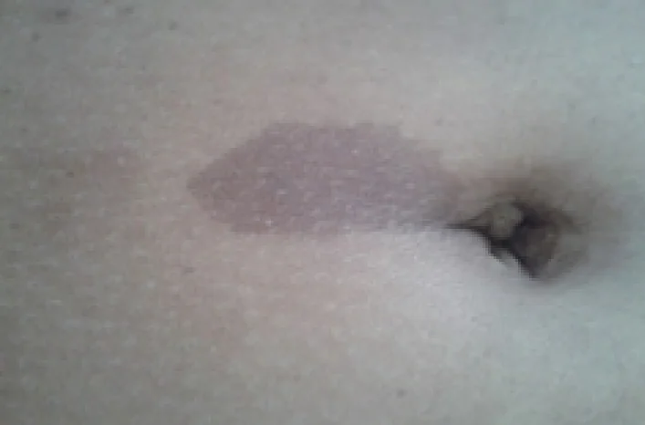 A clinical photograph of the abdomen showing a large, uniformly pigmented light-brown macule with a well-defined border.