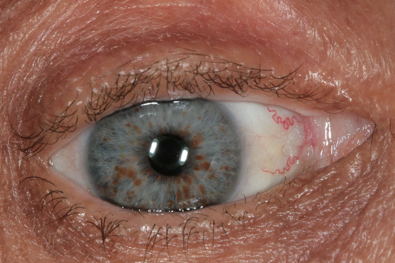A close-up photograph of an eye showing multiple small raised brown nodules scattered across a blue-grey iris.