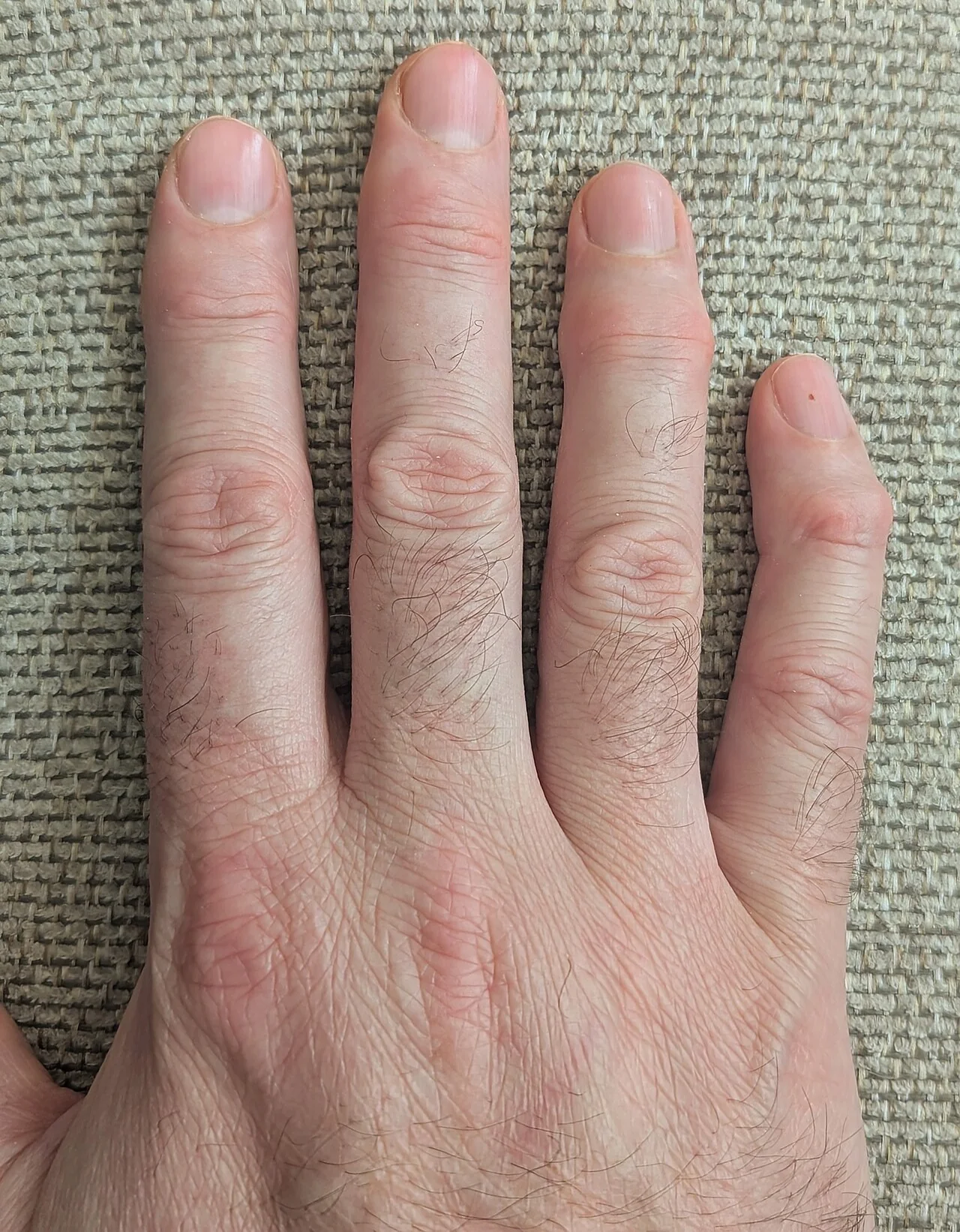Photograph of a hand showing bony swellings at the distal interphalangeal joints, consistent with Heberden's nodes of hand osteoarthritis.