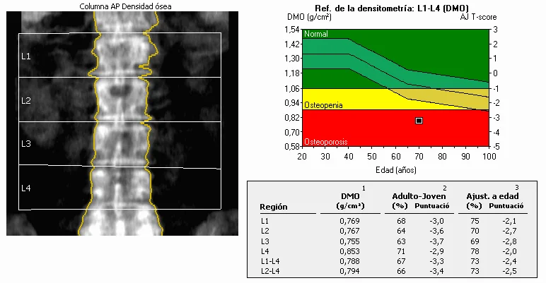 DEXA scan printout of the lumbar spine, showing a bone mineral density curve plotted against age with the patient's measured value falling in the osteoporotic range below the -2.5 T-score line.