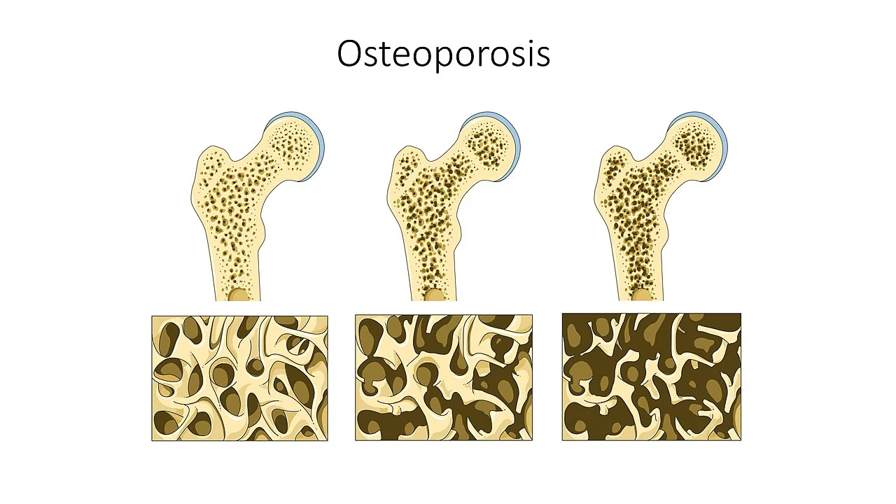 Illustration of three proximal femurs showing progressive loss of internal bone density from normal to severely osteoporotic, with matching close-up panels showing thinning and disconnection of the trabecular network.