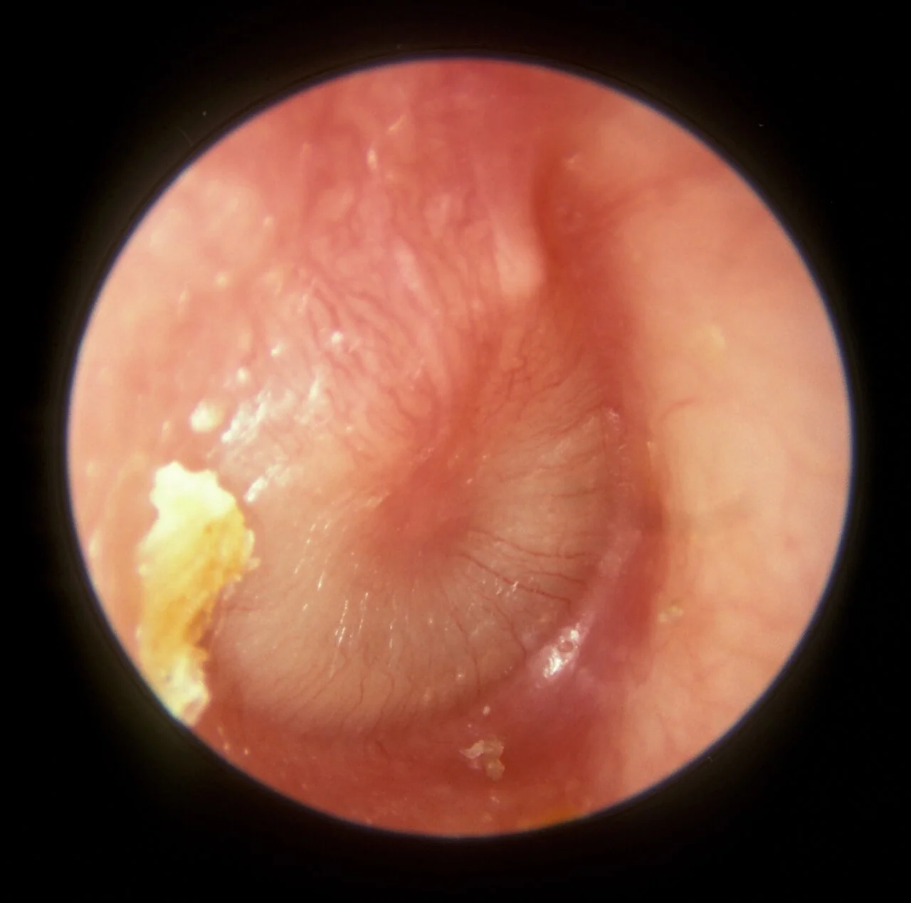 Otoscopic view of a bulging, erythematous tympanic membrane in acute otitis media, with dilated radial blood vessels and creamy mucopurulent exudate visible behind the drum.