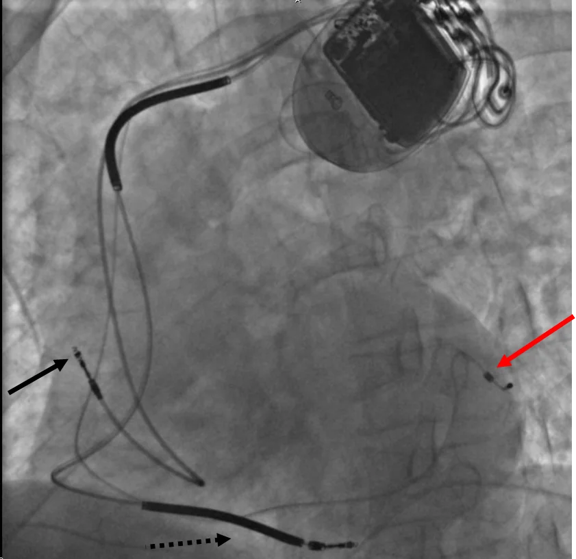 Fluoroscopic image of the chest showing a large device generator with three leads running into the heart, marked by a solid black arrow, a dashed black arrow and a red arrow at their respective tips.