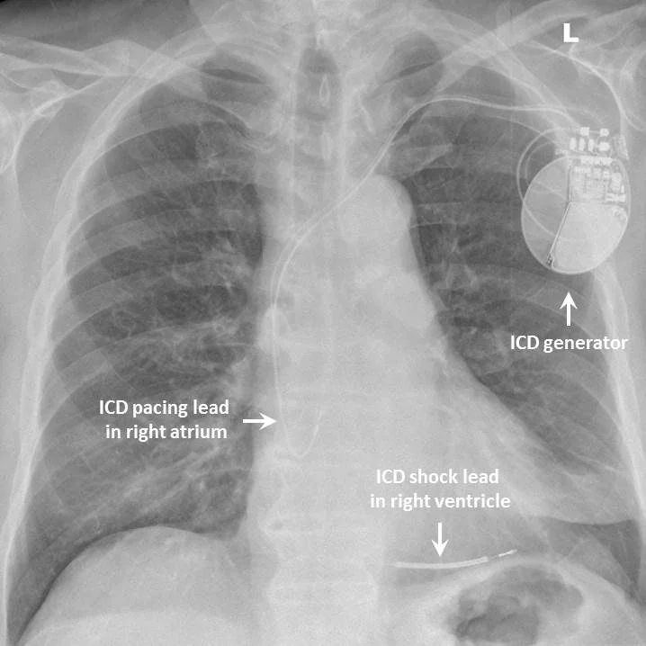 Frontal chest X-ray with labels and arrows identifying an implantable cardioverter defibrillator generator in the left upper chest, a pacing lead tip in the right atrium, and a thicker shock lead with a visible coil in the right ventricle.