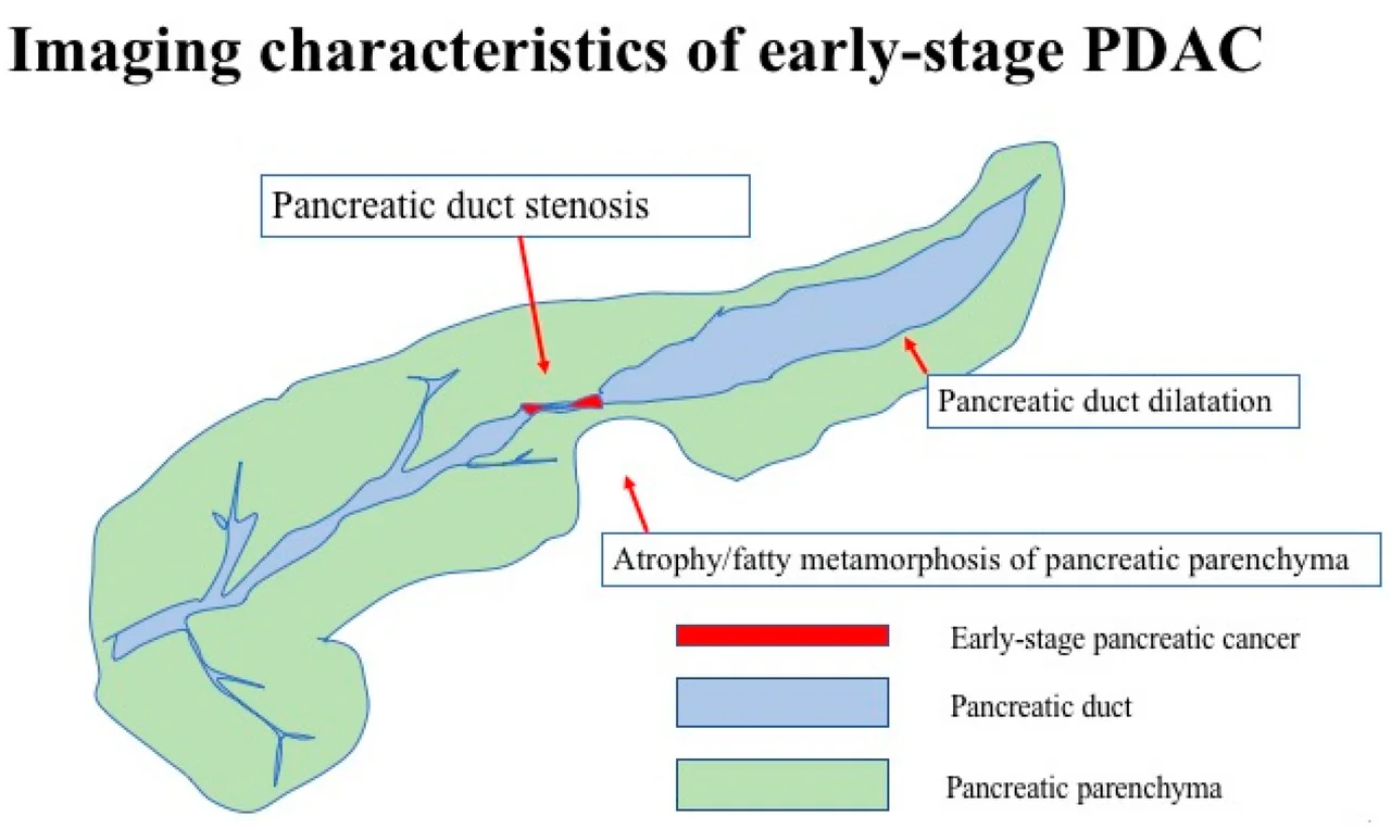 Cross-sectional imaging showing features of early-stage pancreatic ductal adenocarcinoma, including a hypodense pancreatic mass with upstream duct dilatation.