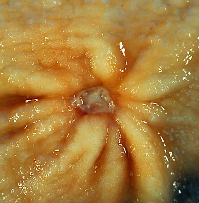 Photograph of a resected stomach specimen showing a benign gastric antral ulcer with radiating mucosal folds.