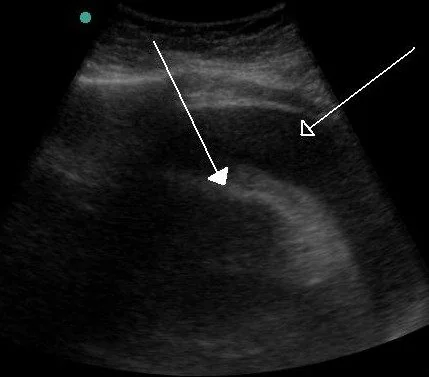 Cardiac ultrasound image showing a broad black echo-free space surrounding the brighter curved wall of the heart, indicating a large volume of fluid within the pericardial sac.