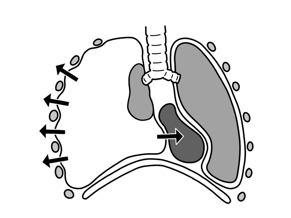 Line diagram of the thorax in cross-section showing one hemithorax filled with air and no lung markings, the collapsed lung pushed towards the opposite side, the trachea deviated away from the air-filled side, and arrows indicating pressure pushing the mediastinum across.