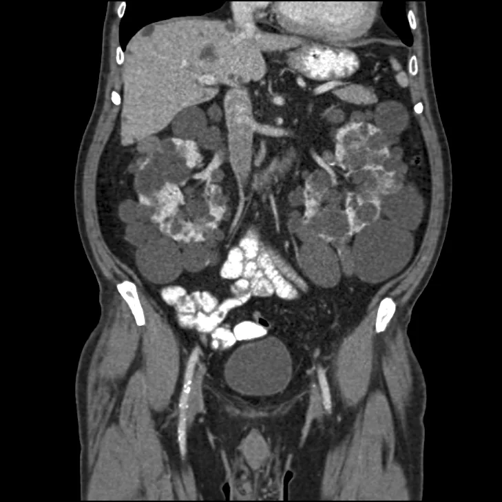 Axial abdominal CT scan showing both kidneys grossly enlarged and replaced by numerous rounded fluid-filled cysts of varying size, with cysts also visible in the liver.