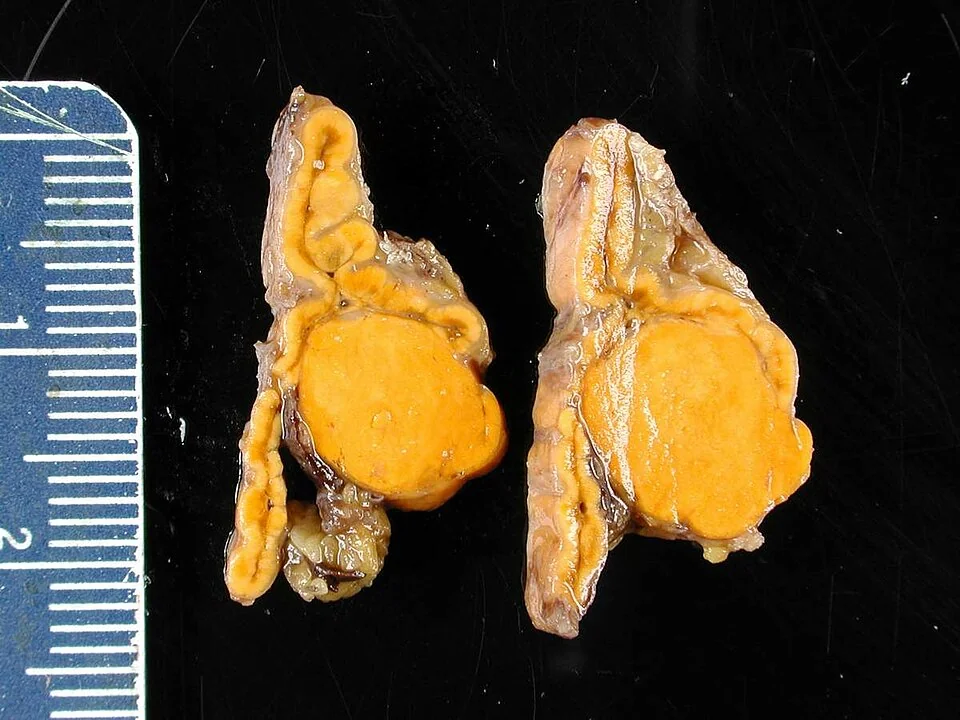 Two cut slices of an adrenal gland photographed beside a centimetre ruler, each showing a well-circumscribed, bright golden-yellow rounded nodule about 1.5 cm across within the thin surrounding cortex.