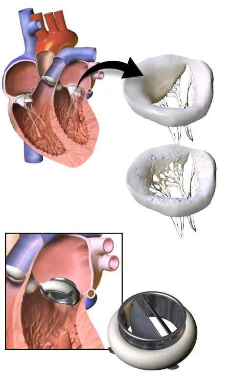 Illustration of a mechanical prosthetic heart valve with two hinged semicircular leaflets mounted in a circular housing surrounded by a fabric sewing ring.
