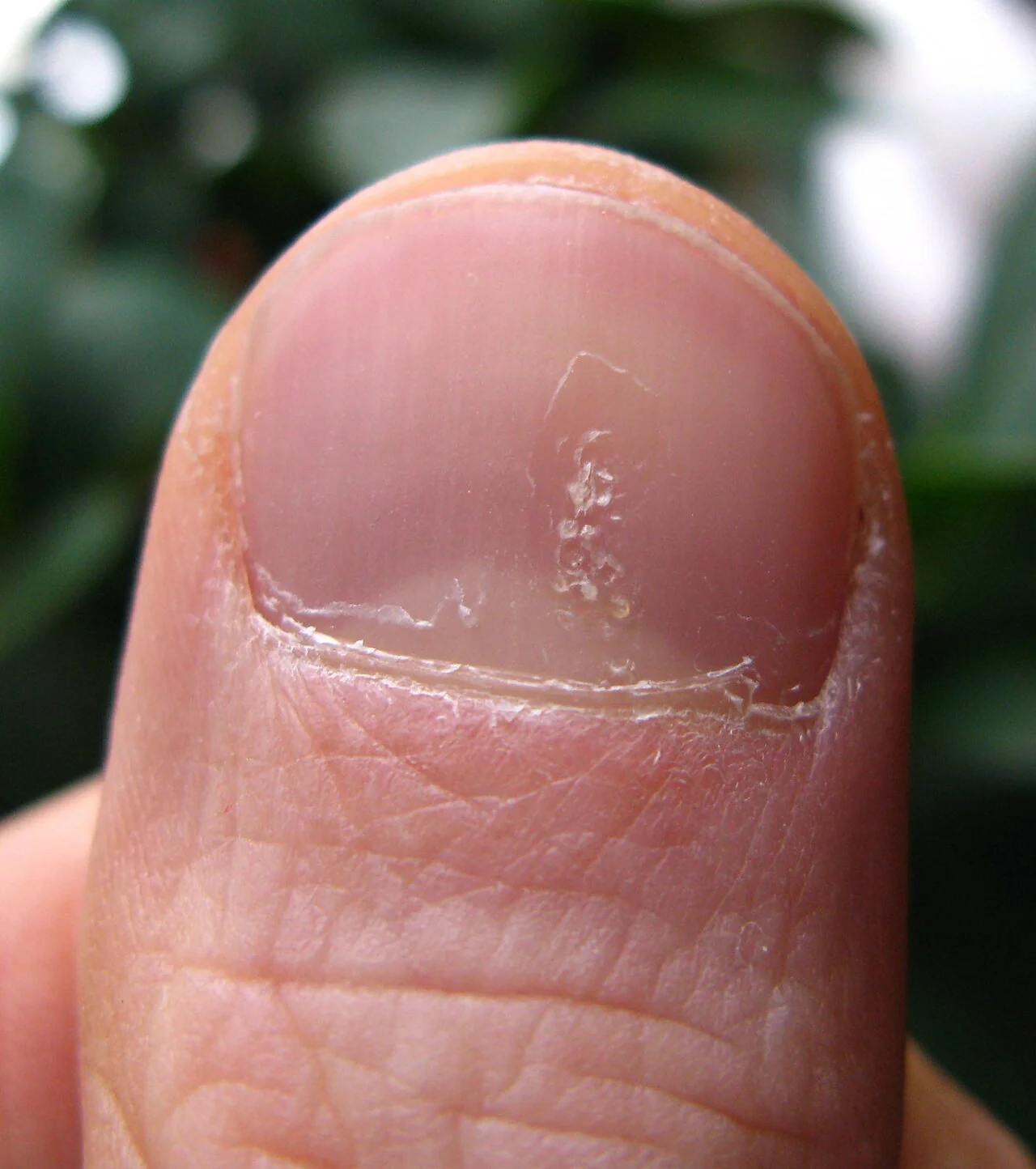 Close-up photograph of a fingernail with multiple small pits scattered across the nail plate, characteristic of nail psoriasis.