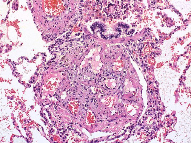 Microscope image of lung tissue stained pink and purple, showing a small pulmonary artery whose lumen is filled and expanded by a disorganised tuft of proliferating cells and small vascular channels.