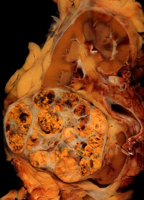 Gross pathology photograph of a bisected kidney showing a large well-circumscribed yellowish tumour at the lower pole bulging beyond the cortical surface, contrasting with the adjacent normal brown renal parenchyma.