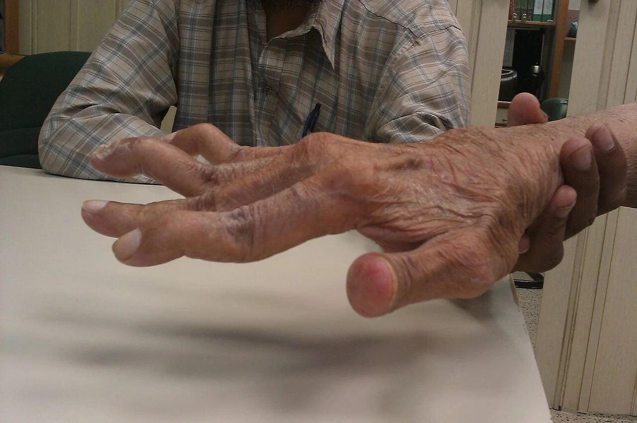 Photograph of a hand with established rheumatoid arthritis, showing ulnar deviation of the fingers at the metacarpophalangeal joints and swan neck deformity of several digits.