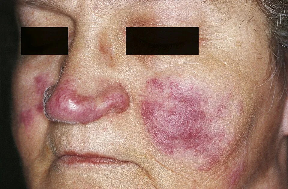 Close-up photograph of a face showing dusky red-purple indurated plaques and nodules over the nose, both cheeks and the periorbital skin.