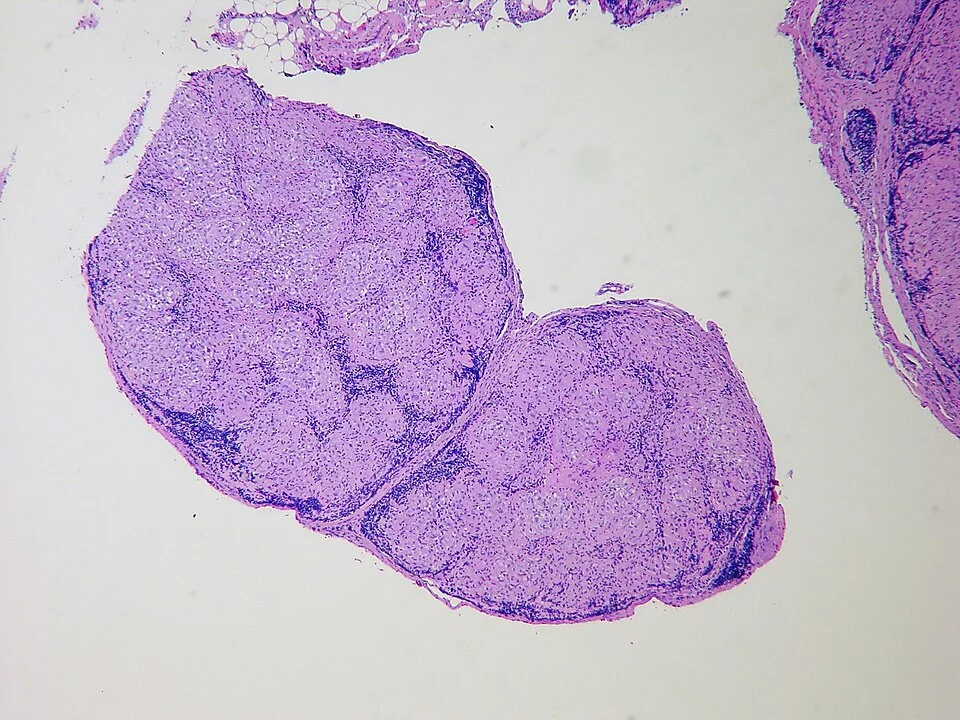 Low-power histology of a lymph node almost entirely replaced by numerous rounded, uniform, pale-staining epithelioid granulomas packed together, with no central necrosis in any of them.