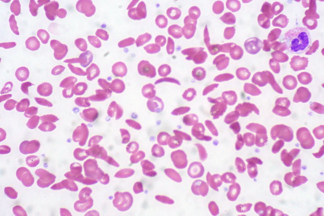 Peripheral blood film showing elongated, crescent-shaped sickle cells alongside target cells and polychromasia.