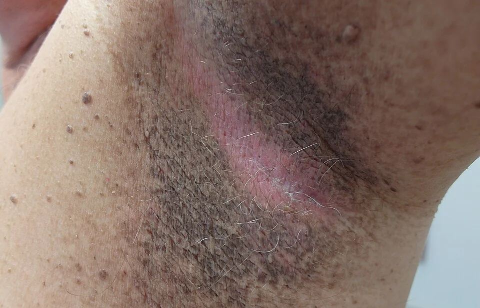 Photograph of the axilla showing velvety, thickened, hyperpigmented skin with surrounding skin tags, typical of acanthosis nigricans.