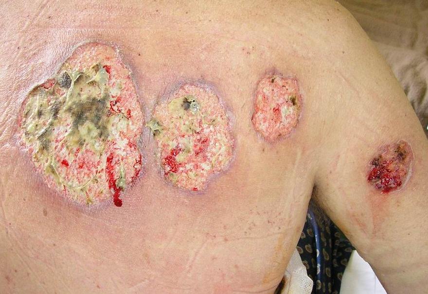 Photograph of the upper back showing several ulcers with violaceous, undermined borders and sloughy, purulent bases, typical of pyoderma gangrenosum.