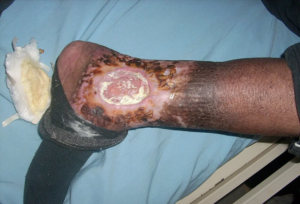 Photograph of a venous leg ulcer above the ankle, showing a shallow, irregular ulcer with a moist granulating base, surrounded by hyperpigmented, hardened skin typical of lipodermatosclerosis.