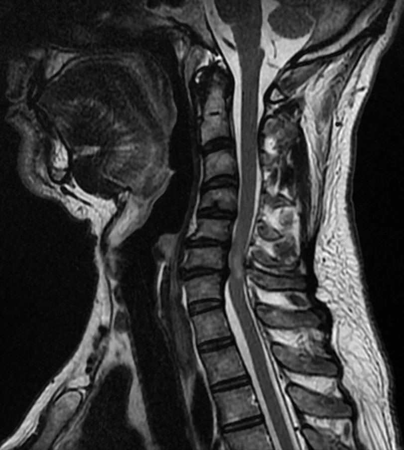 Sagittal T2-weighted MRI of the cervical spine showing loss of the normal cervical lordosis, degenerative disc disease with a posterior disc protrusion, and indentation of the spinal cord at the C6-C7 level.