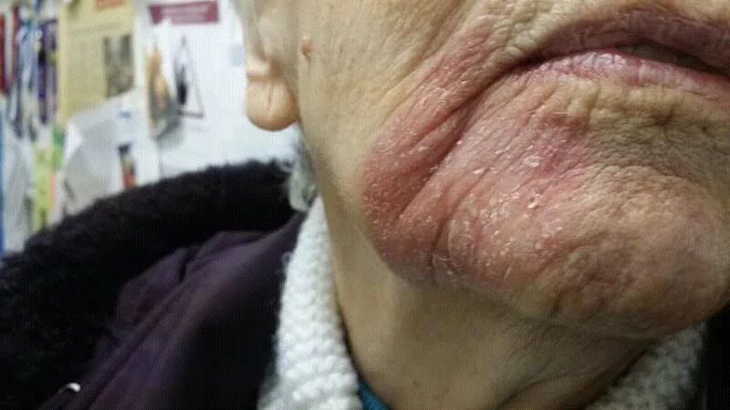 Photograph of the chin and jawline of an older adult showing a well-demarcated, erythematous, scaly plaque typical of Bowen disease.