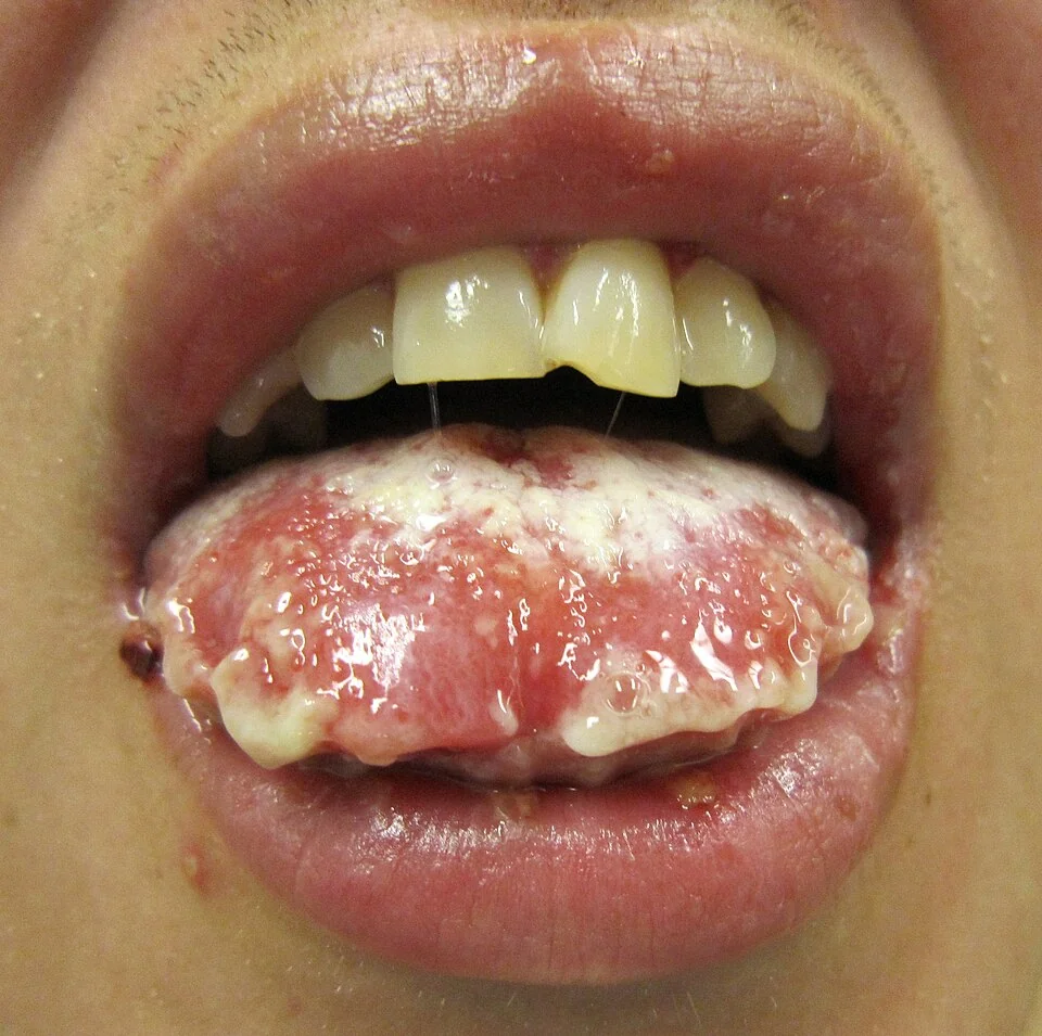 Close-up photograph of the mouth showing haemorrhagic erosions and a thick, sloughing coating on the lips and tongue, characteristic of Stevens-Johnson syndrome mucosal involvement.