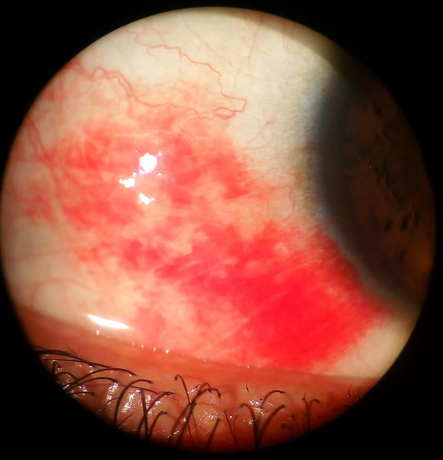 Slit lamp photograph of an eye with a subconjunctival haemorrhage, showing a flat, uniformly bright red area of blood with a sharply defined border on the white of the eye, with a clear cornea and normal pupil.