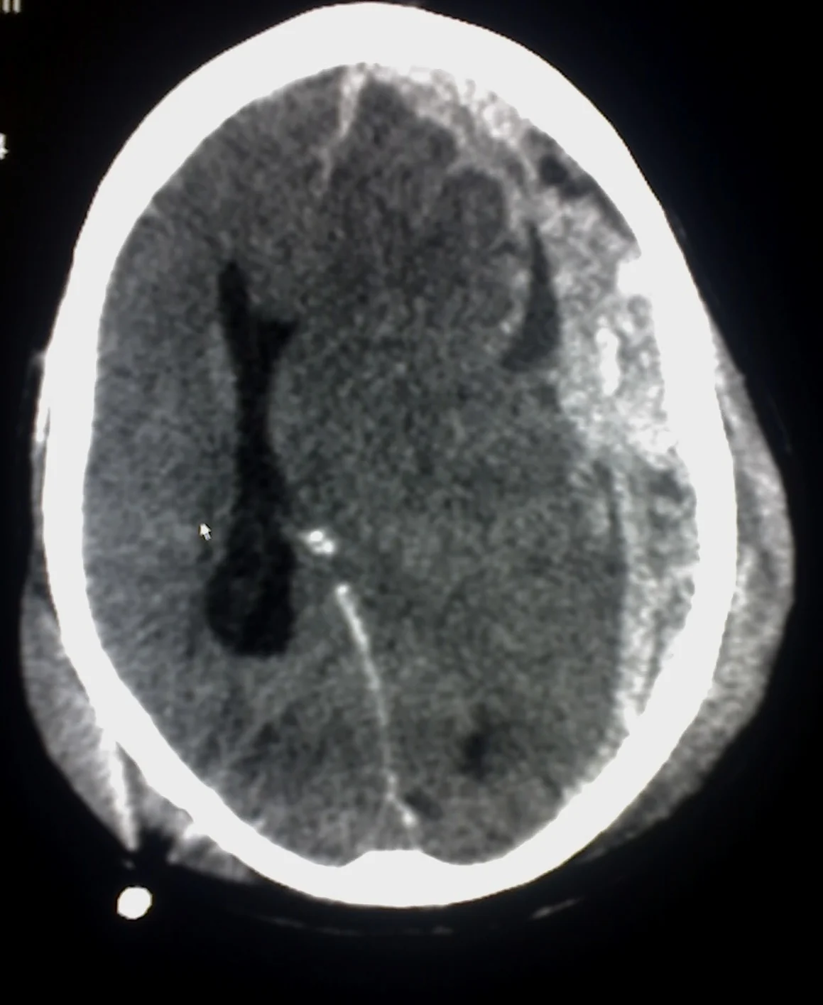 Axial CT brain scan showing a crescent-shaped, concave collection along the inner surface of the skull, causing compression of the underlying brain and midline shift, consistent with subdural haemorrhage.
