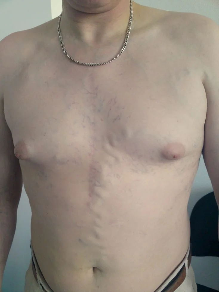 Photograph of a patient's chest and upper abdomen, with the head not shown, demonstrating a network of prominent dilated superficial veins running vertically over the chest wall and abdomen.