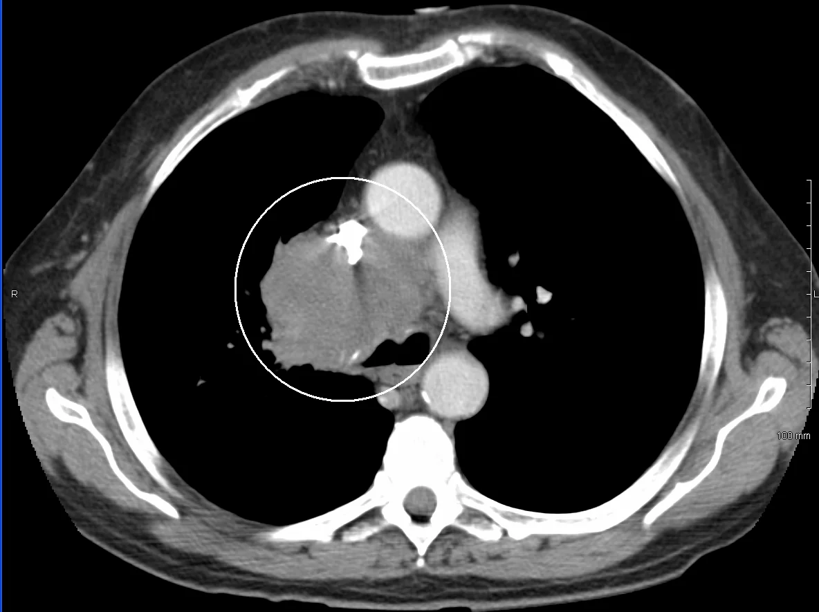 Axial CT slice through the chest with a white circle drawn around a soft tissue mass in the right hilar and mediastinal region, lying adjacent to the great vessels.