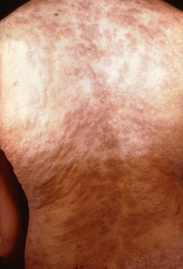 Photograph of a widespread reddish-brown maculopapular rash across the back in secondary syphilis.