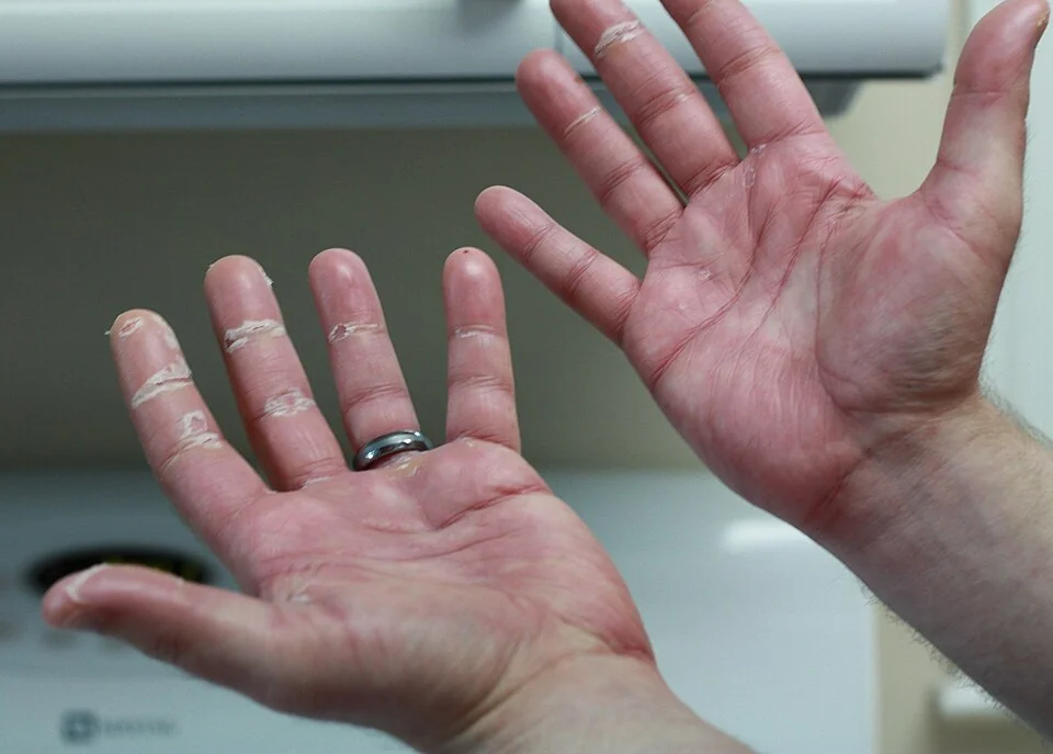 The palms of both hands showing diffuse, well-demarcated erythema with dry, peeling and cracked skin over the pressure areas of the fingers and palm.