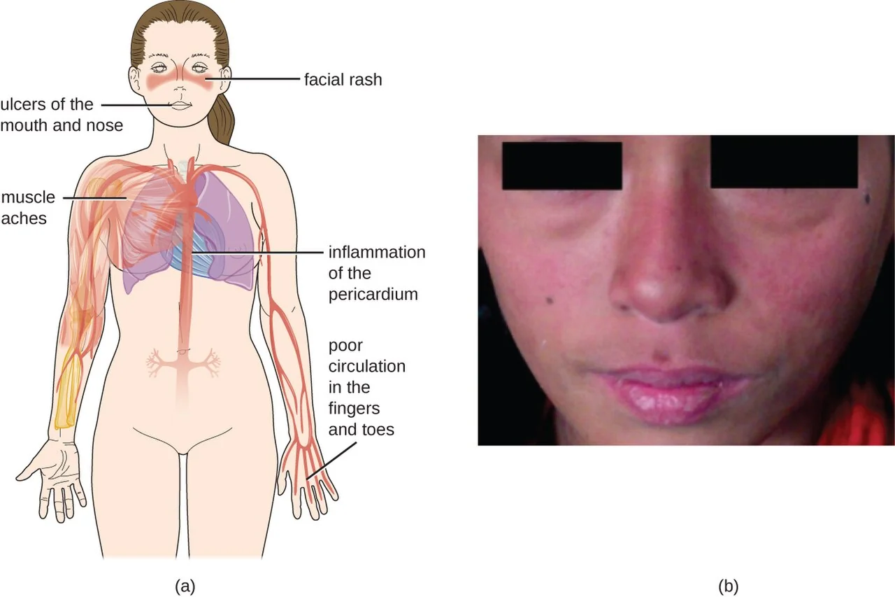 Photograph of a face showing an erythematous malar (butterfly) rash across both cheeks and the bridge of the nose, sparing the nasolabial folds.