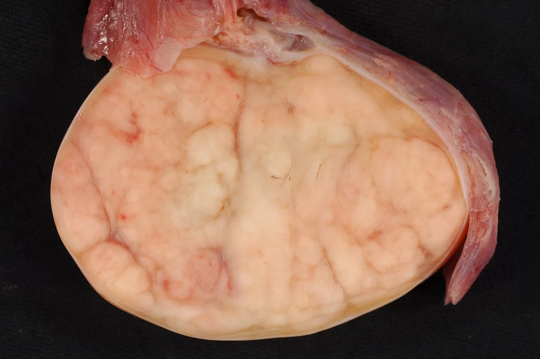 Gross pathology photograph of a bisected testis from a radical orchidectomy specimen showing a large, well-circumscribed, homogeneous pale cream-coloured tumour replacing most of the testicular tissue.