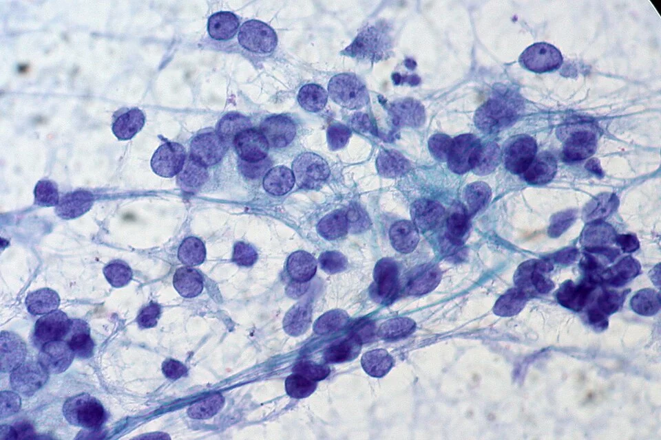 Papanicolaou-stained fine needle aspirate cytology slide showing a cohesive sheet of thyroid follicular cells with enlarged, overlapping, pale nuclei containing longitudinal grooves and occasional intranuclear inclusions.