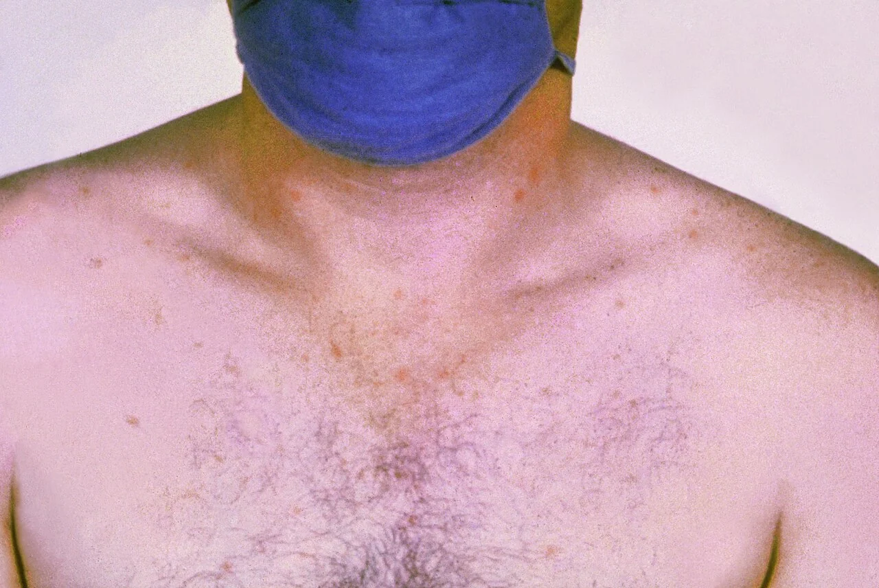 Photograph of the chest of a patient with typhoid fever showing faint, blanching rose-coloured spots.
