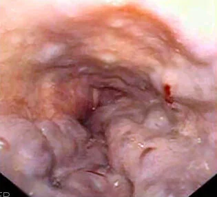 Endoscopic image of the distal oesophagus showing dilated submucosal veins with red wale markings, indicating oesophageal varices at high risk of bleeding.