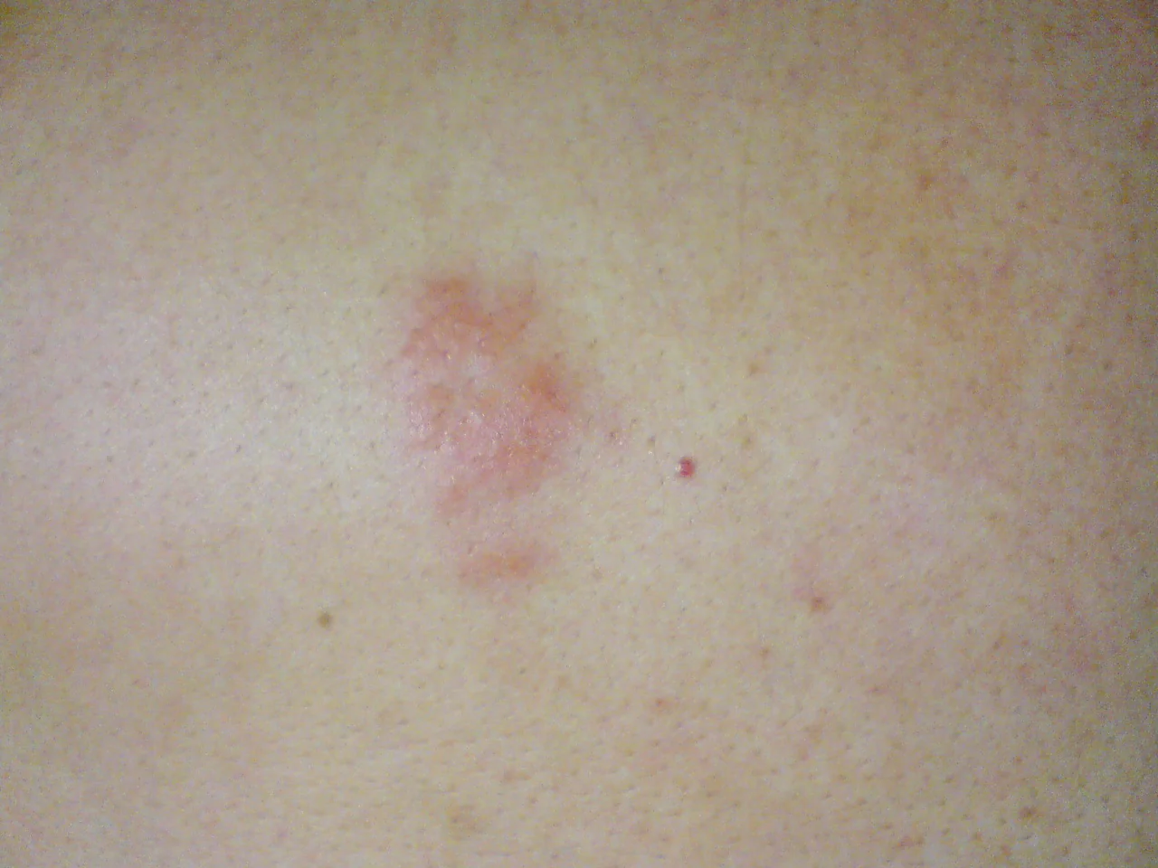 Photograph of a vesicular rash confined to one side of the back, following the distribution of a single dermatome.