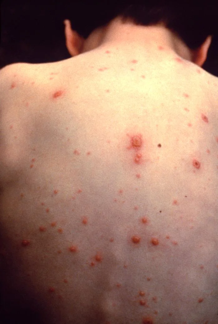 Photograph of a child's torso with multiple vesicular and crusted skin lesions in various stages, typical of chickenpox.