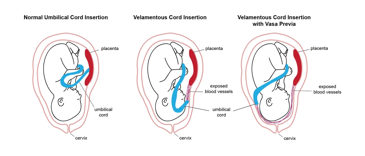 Diagram comparing normal umbilical cord insertion, velamentous cord insertion, and velamentous insertion with vasa praevia in which exposed vessels cross the cervix.