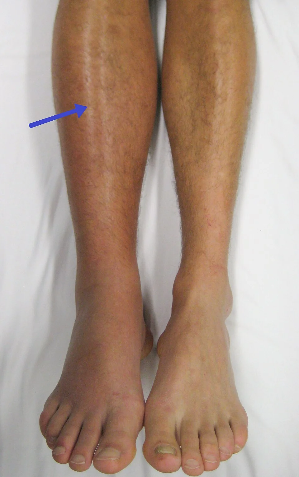 Photograph of a leg with deep vein thrombosis showing marked unilateral swelling and erythema compared with the other leg.