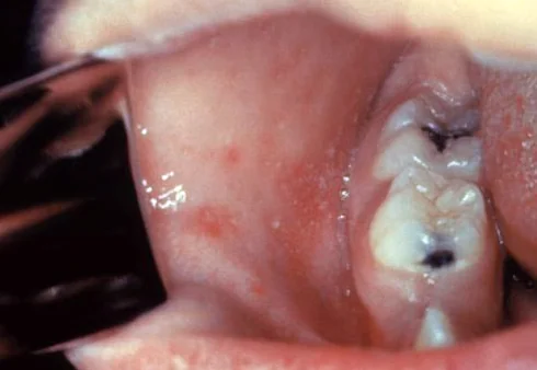 Close-up of the inside of a child's cheek showing multiple tiny white spots on a reddened buccal mucosa.