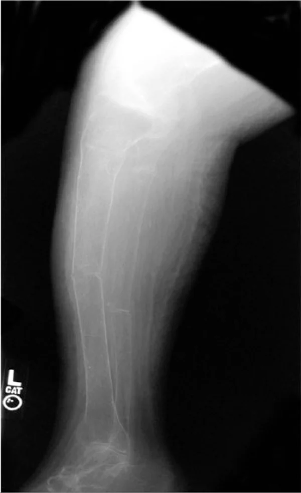 Lateral radiograph of a tibia and fibula showing markedly thinned, washed-out looking bones with indistinct cortical margins and transverse fracture lines through the mid-shafts of both bones.