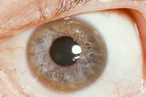 Close-up photograph of an eye showing a golden-brown ring of copper pigment at the outer edge of the cornea, a Kayser-Fleischer ring.