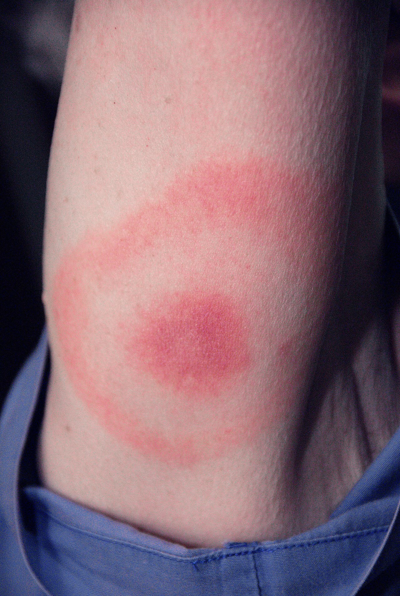 Photograph of an expanding red rash with a paler central area, forming a target or bullseye pattern, on a patient's arm.